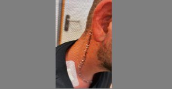 אישום: תקפו קשות גבר בחוף אשדוד עם בקבוק זכוכית